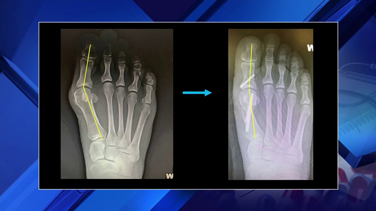 What Can I Do About My Bunion