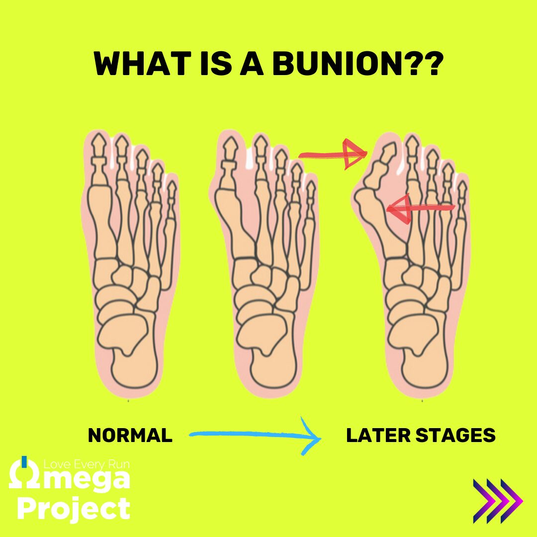 What is a Bunion